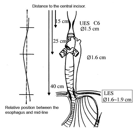 CITEC™ Cardia Umbrella Fistula Occluding Esophageal Stent Supplier ...