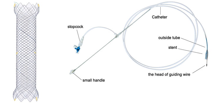 CITEC™ Duodenal/Colonic Stent with TTS Introducer System - Colonic ...